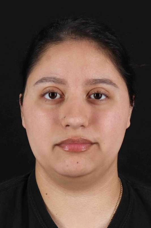 Neck Liposuction Before & After Patient #5665