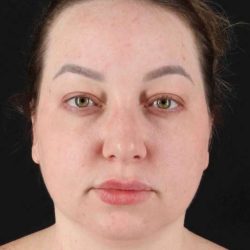 Neck Liposuction Before & After Patient #5676