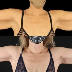 Brachioplasty (Arm Lift) Before & After Patient #1134