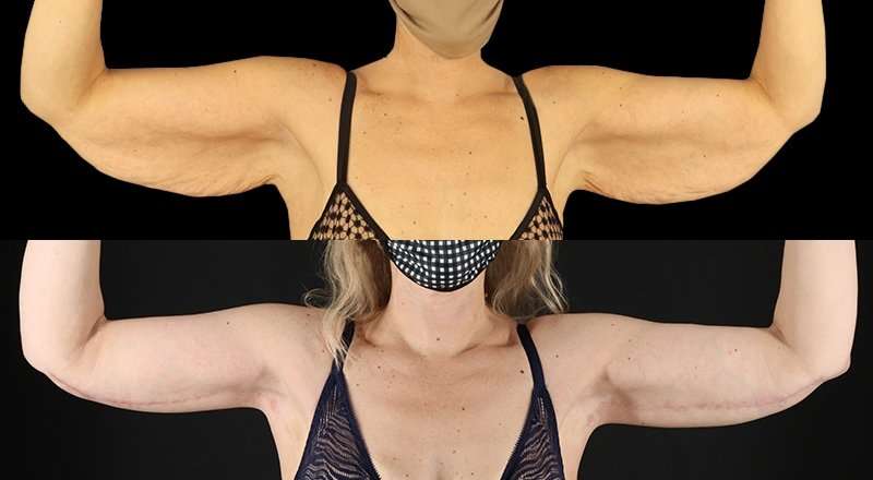Brachioplasty (Arm Lift) Before & After Patient #1134