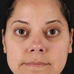 Neck Liposuction Before & After Patient #5720