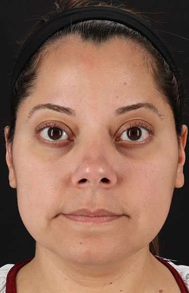 Neck Liposuction Before & After Patient #5720