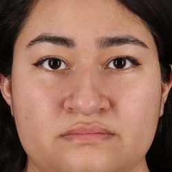 Neck Liposuction Before & After Patient #5742