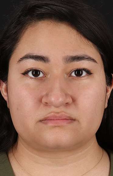 Neck Liposuction Before & After Patient #5742