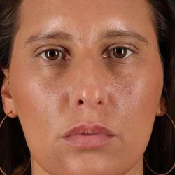 Neck Liposuction Before & After Patient #5753