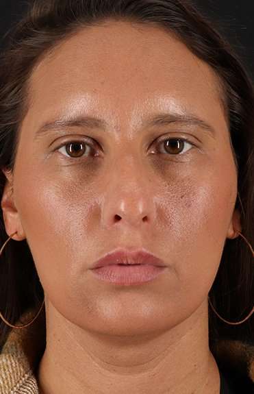 Neck Liposuction Before & After Patient #5753