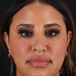 Neck Liposuction Before & After Patient #5762