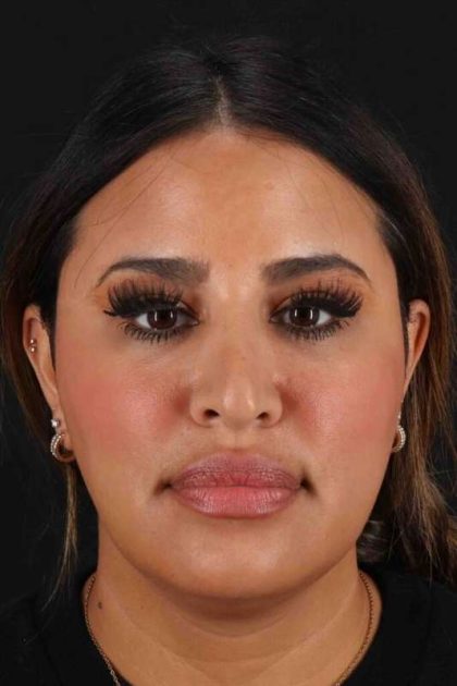 Neck Liposuction Before & After Patient #5762