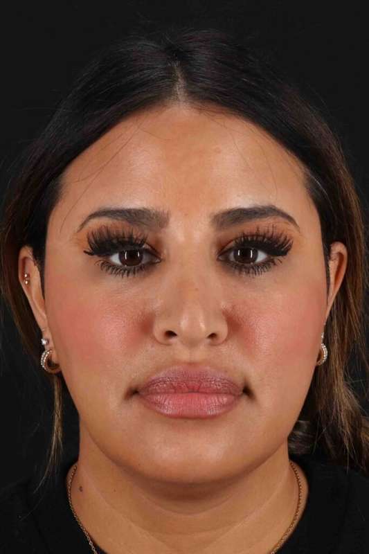Neck Liposuction Before & After Patient #5762