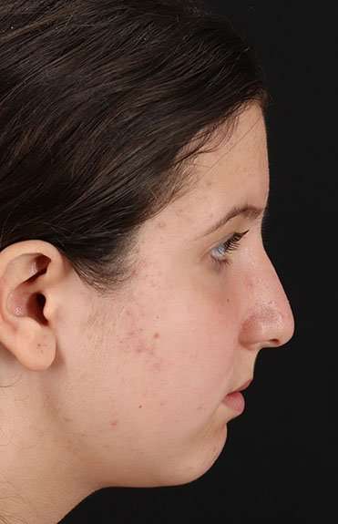 Neck Liposuction Before & After Patient #5765