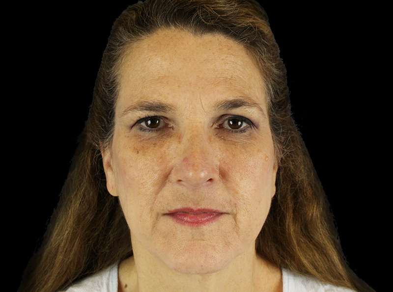 Fraxel&trade; Laser Before & After Patient #5787