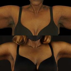 Brachioplasty (Arm Lift) Before & After Patient #1137