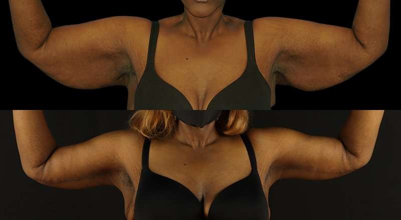 Brachioplasty (Arm Lift) Before & After Patient #1137