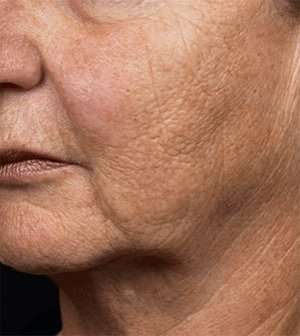 Fraxel™ Laser Before & After Patient #5801