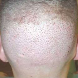 Hair Restoration Before & After Patient #5804
