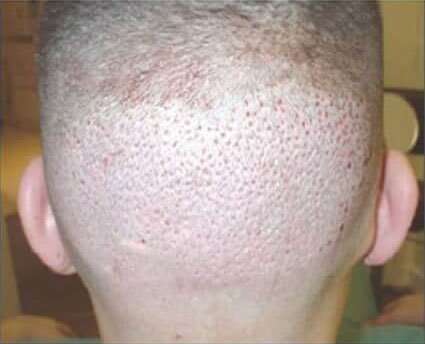 Hair Restoration Before & After Patient #5804