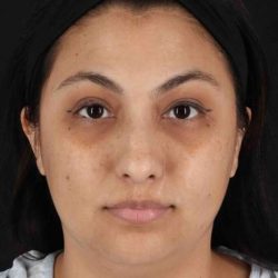 Rhinoplasty Before & After Patient #5826