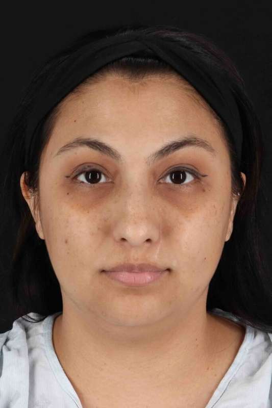 Rhinoplasty Before & After Patient #5826