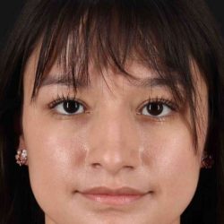 Rhinoplasty Before & After Patient #5837