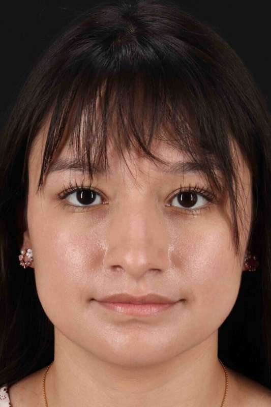 Rhinoplasty Before & After Patient #5837