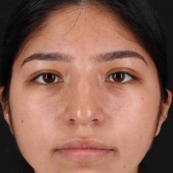 Rhinoplasty Before & After Patient #5848