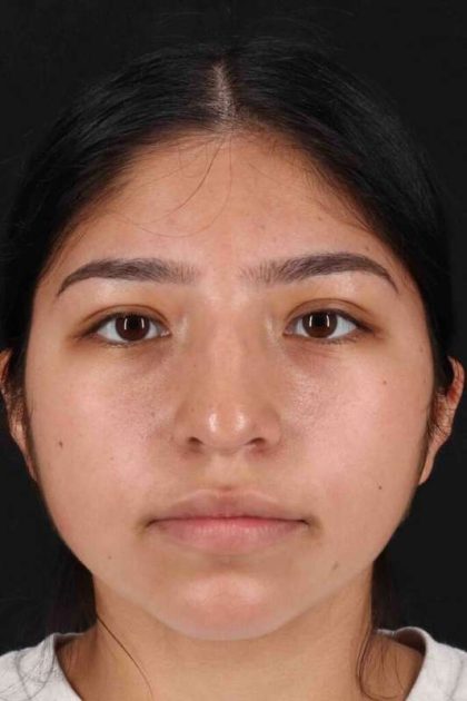 Rhinoplasty Before & After Patient #5848