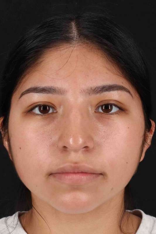 Rhinoplasty Before & After Patient #5848