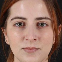Rhinoplasty Before & After Patient #5859