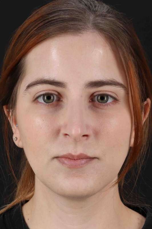 Rhinoplasty Before & After Patient #5859