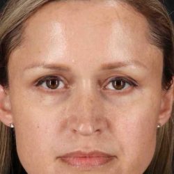 Rhinoplasty Before & After Patient #5870