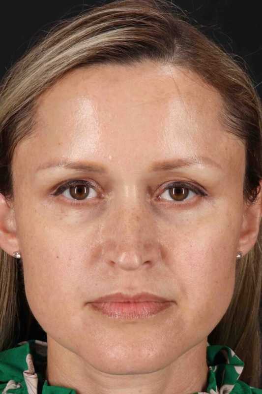 Rhinoplasty Before & After Patient #5870