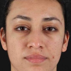 Rhinoplasty Before & After Patient #5881