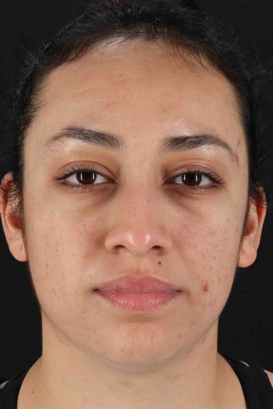 Rhinoplasty Before & After Patient #5881