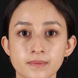 Rhinoplasty Before & After Patient #5892