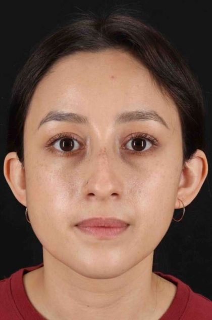 Rhinoplasty Before & After Patient #5892
