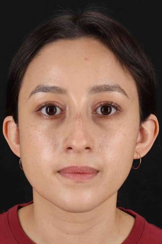 Rhinoplasty Before & After Patient #5892
