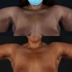 Brachioplasty (Arm Lift) Before & After Patient #1140