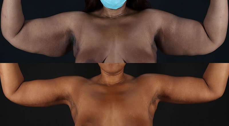 Brachioplasty (Arm Lift) Before & After Patient #1140