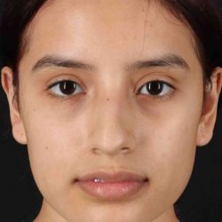 Rhinoplasty Before & After Patient #5903