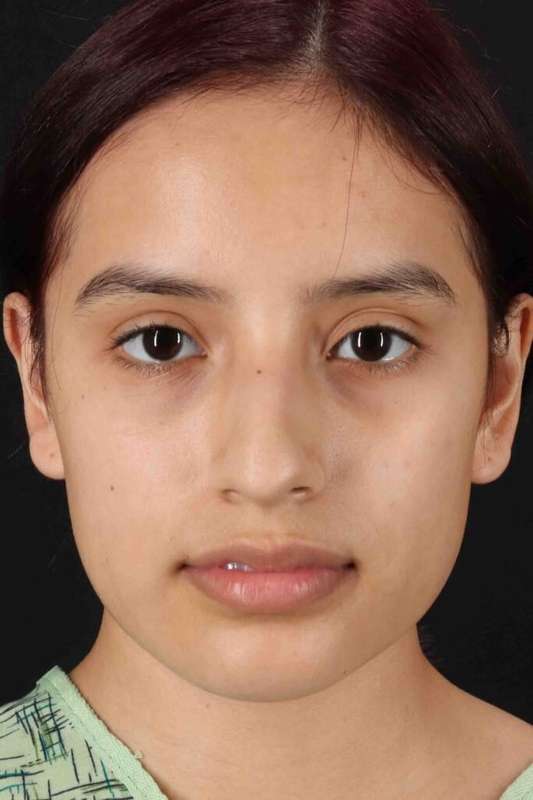 Rhinoplasty Before & After Patient #5903