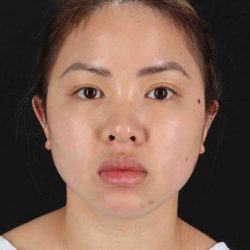 Rhinoplasty Before & After Patient #5914
