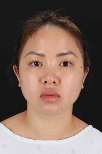 Rhinoplasty Before & After Patient #5914