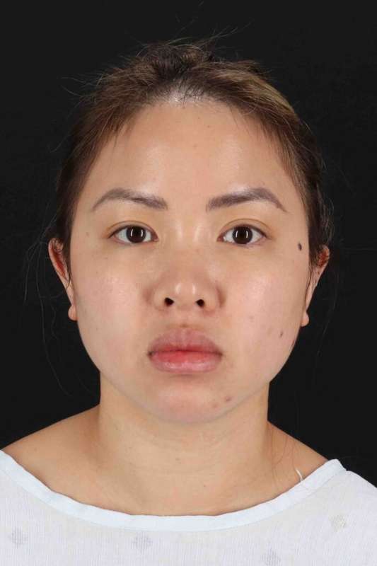 Rhinoplasty Before & After Patient #5914