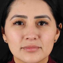 Rhinoplasty Before & After Patient #5925