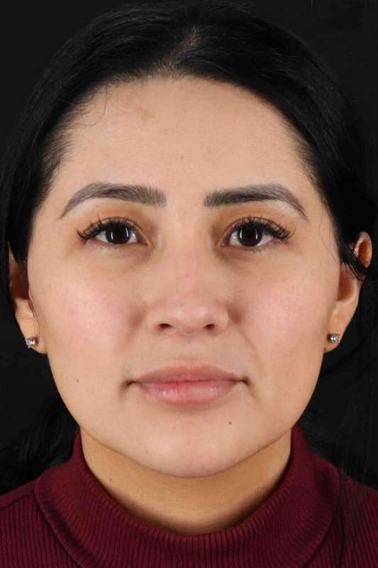 Rhinoplasty Before & After Patient #5925