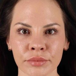 Rhinoplasty Before & After Patient #5936
