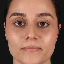 Rhinoplasty Before & After Patient #5947