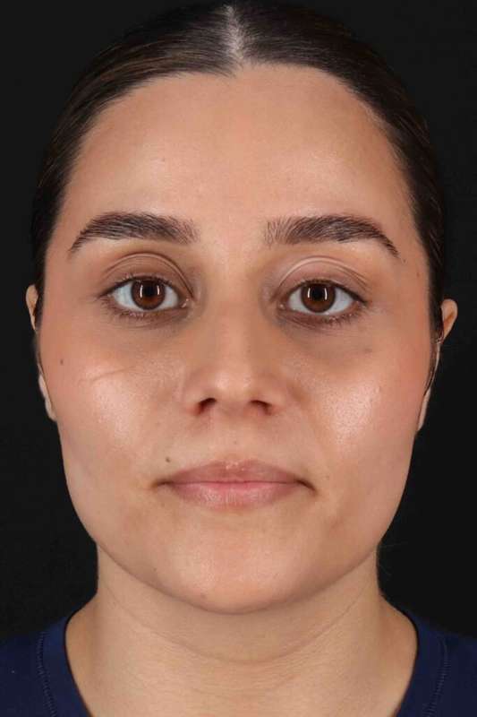 Rhinoplasty Before & After Patient #5947