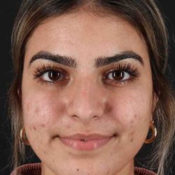 Rhinoplasty Before & After Patient #5958