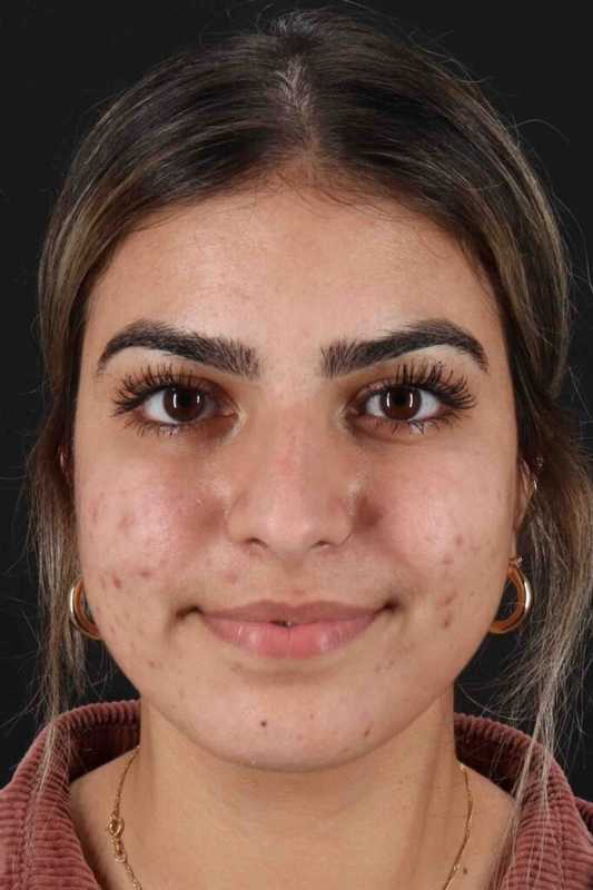 Rhinoplasty Before & After Patient #5958